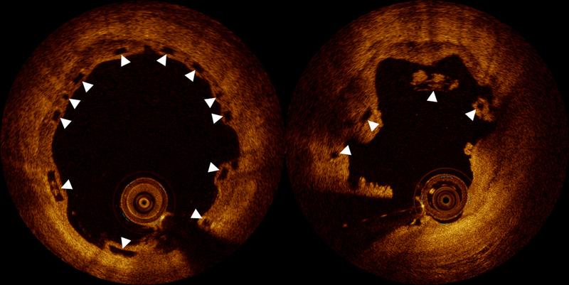 Obwohl zehn Monate nach Implantation die Position des Bio-Stents korrekt ist (links), sind sechs Monate später die Stentstreben eingebrochen (Optische Kohärenztomographie).