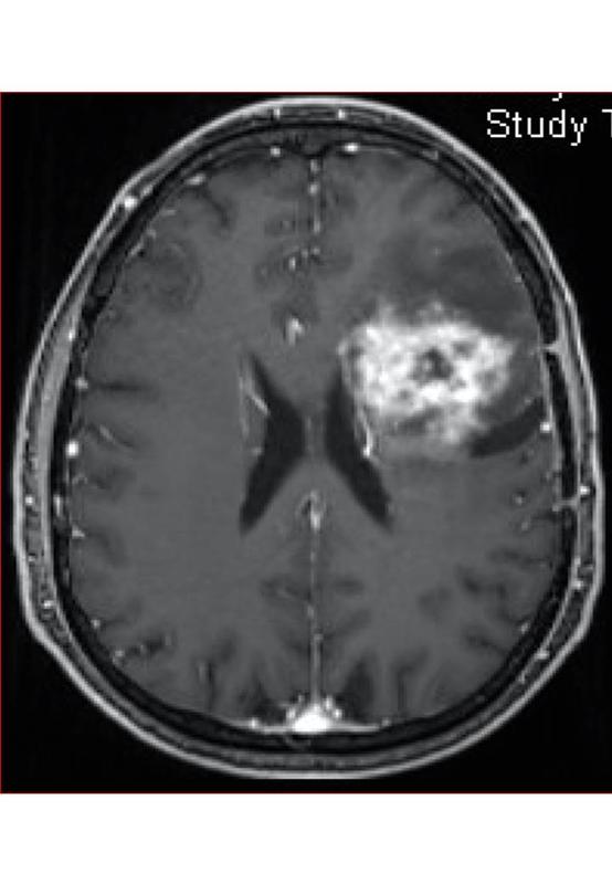 Hirntumor vom Typ Glioblastom
