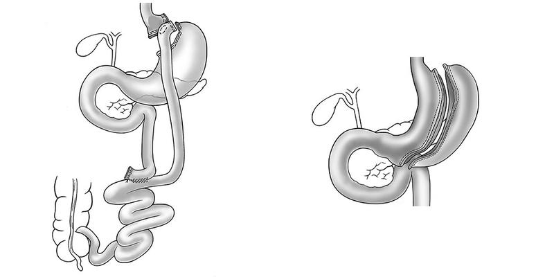 Two types of surgery for severe obesity: In the case of gastric bypass, the stomach is bypassed by a part of the small intestine (left), in the case of the peritoneum, the volume is reduced (right).