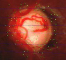 Aufnahme eines Sehnervenkopfes mit Identifikationspunkten und -linien, die zur dreidimensionalen Rekonstruktion genutzt werden. Gut sind die Blutgefäße zu erkennen.