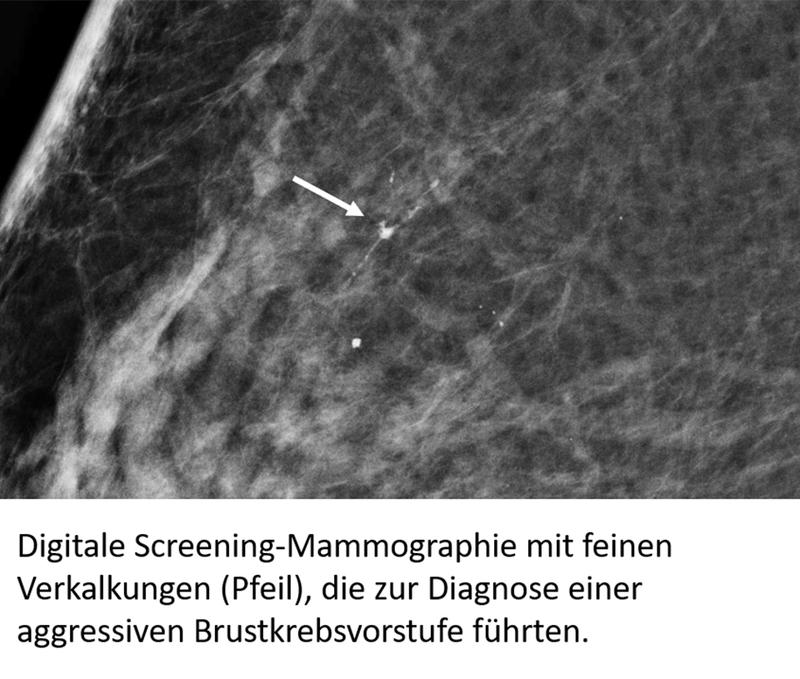 Digitale Screening-Mammographie mit feinen Verkalkungen (Pfeil), die zur Diagnose einer aggressiven Brustkrebsvorstufe führten.