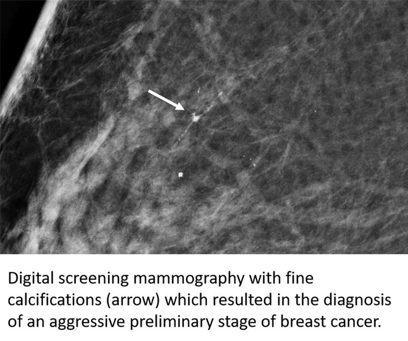 Digital screening mammography with fine calcifications (arrow) which resulted in the diagnosis of an aggressive preliminary stage of breast cancer.