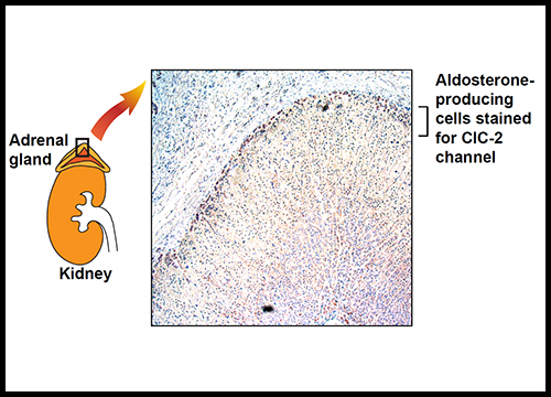 In the familial form of hyperaldosteronism, a gene mutates that carries the information for the construction of the CIC-2 channel in the cell membrane. 