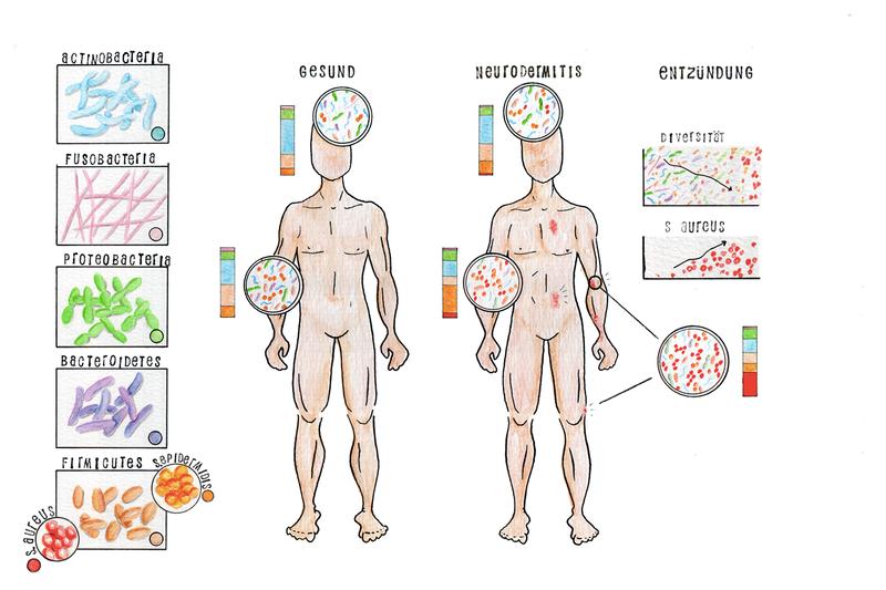 Im Fall eines Ekzems bei Neurodermitis-Patienten, also einer akuten Entzündung der Haut, sinkt die Vielfältigkeit der Bakterien weiter ab und der Anteil bestimmter „schlechter Bakterien“ steigt an.