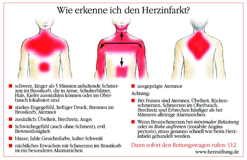 Herzinfarkt-Schmerzorte