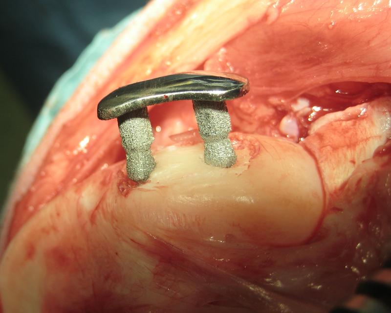 Frankfurter Inlay aus dem ehemaligen LOEWE-Schwerpunkt „Präventive Biomechanik“: Teil-Knorpel-Prothese im Knie.