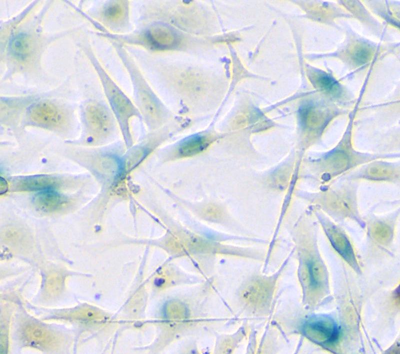Melanomzellen unter dem Mikroskop