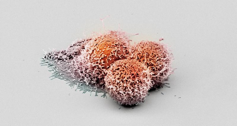 Mit dem Rasterelektronenmikroskop aufgenommene Krebszellen