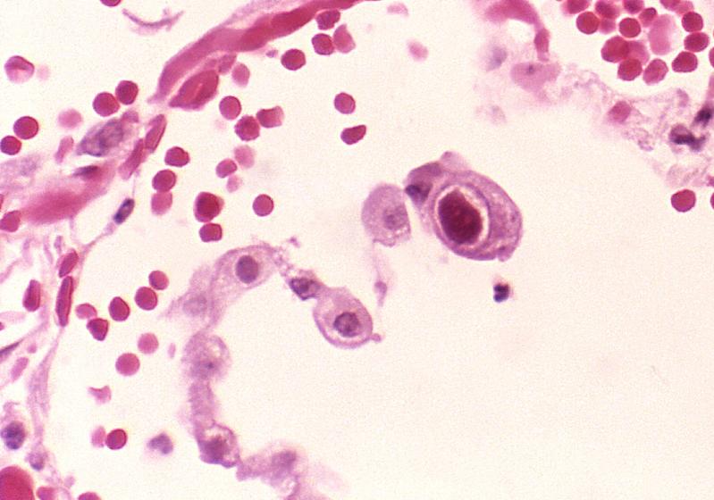 Das mikroskopische Bild zeigt eine Cytomegalievirus-Infektion in der Lunge. Im Zentrum sind die typischen Riesenzellen zu erkennen.