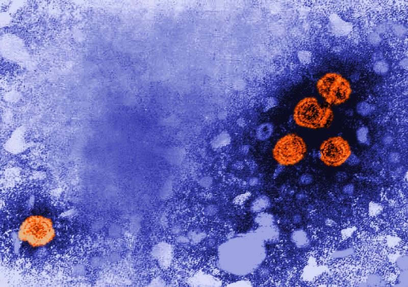 Hepatitis-B-Viruspartikel orange gefärbt; elektronenmikroskopische Aufnahme
