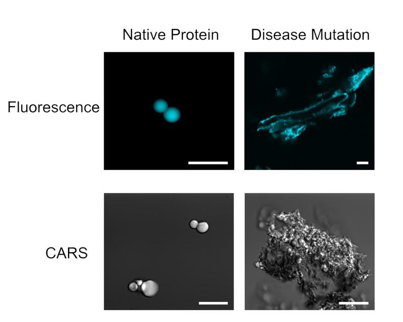 Native and disease mutated RNP granule proteins. Scale bar is 20 Native and disease mutated RNP granule proteins. Scale bar is 20μm 