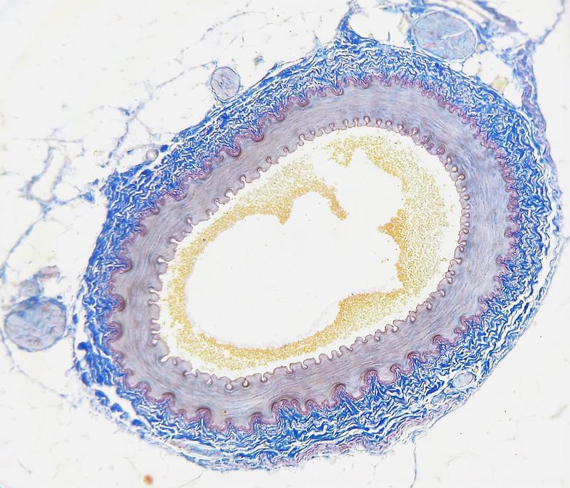 Querschnitt einer menschlichen Arterie mit Verkalkungen (gelb).