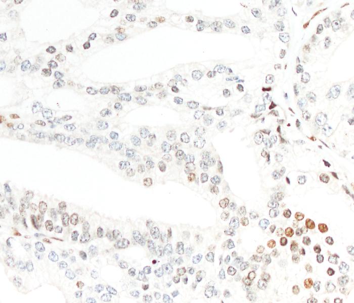 Lokal begrenztes, langsam wachsendes Prostatakarzinom, bei dem nur wenige Zellen (braun gefärbt) eine erhöhte Aktivität des Krebsstammzellgens EVI-1 zeigen.