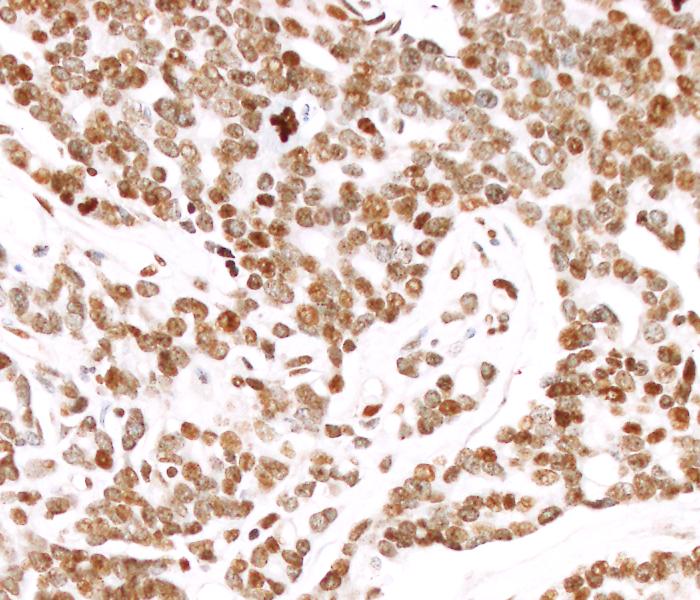 Fast alle Zellen eines metastasierten und schnell wachsenden Prostatakarzinoms (braun gefärbt) zeigen eine erhöhte Aktivität des Krebsstammzellgens EVI-1.