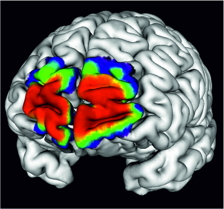 Der dreidimensionale zelluläre JuBrain-Atlas basiert auf mikrostrukturellen Kartierungen von zehn post mortem Gehirnen und zeigt die interindividuelle Variabilität der anatomischen Areale.