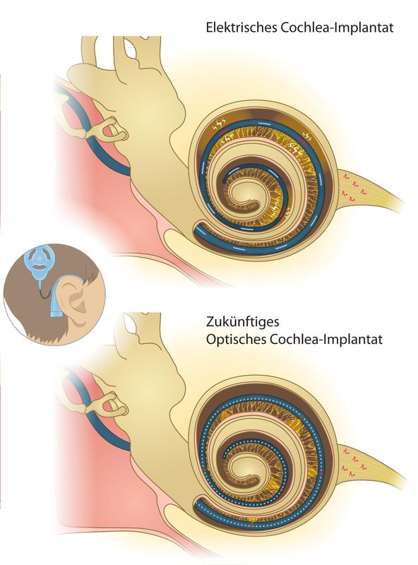Herkömmliches Cochlea-Implantat mit Elektroden zur Stimulation der Nervenzellen in der Hörschnecke (oben) und optogenetisches Implantat (unten) mit kleinen Lichtquellen zur optischen Reizung. 