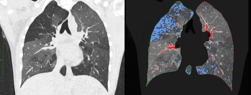 Linke Seite: reguläres CT bei Verdacht auf COPD. Rechte Seite: darübergelegtes qCT. Die blauen Areale stellen die für die COPD typische, gefangene Luft dar („air trapping“).