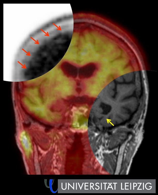 Hybrid-Amyloid-PET/MRT bei Alzheimer-Demenz. Bildausschnitt links oben: Nachweis von sog. Amyloid-Plaques in der Hirnrinde (rote Pfeile) mittels PET-Bildgebung.