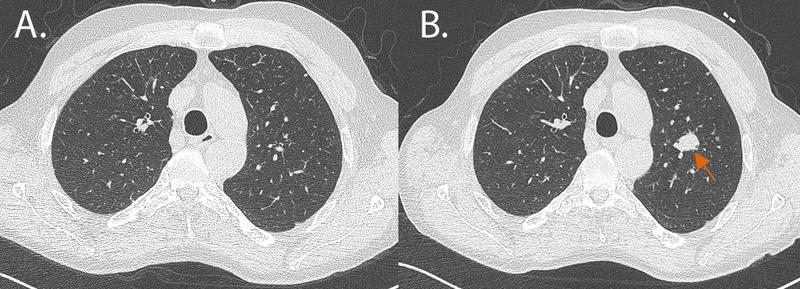 59-jähriger Raucher mit 30 Packungsjahren, Teilnehmer der deutschen LUSI-Studie (Lung Tumor Screening and Intervention).