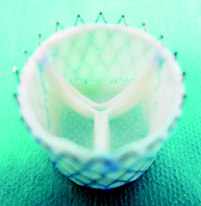 Computer-designed customized regenerative heart valve.
