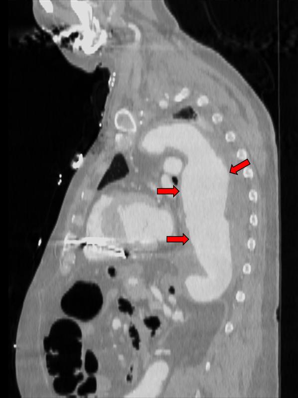 CT-Aufnahme eines Aortenaneurysmas.