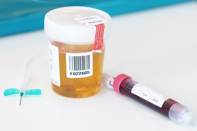 Das CAU-Forschungsteam möchte zur Krebsdiagnose künftig Urin statt Blut verwenden.