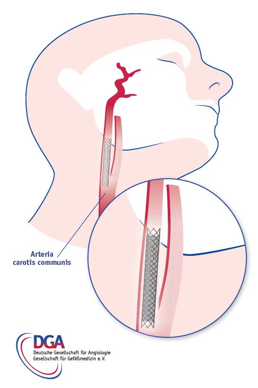 Micromesh-Stent in der Halsschlagader