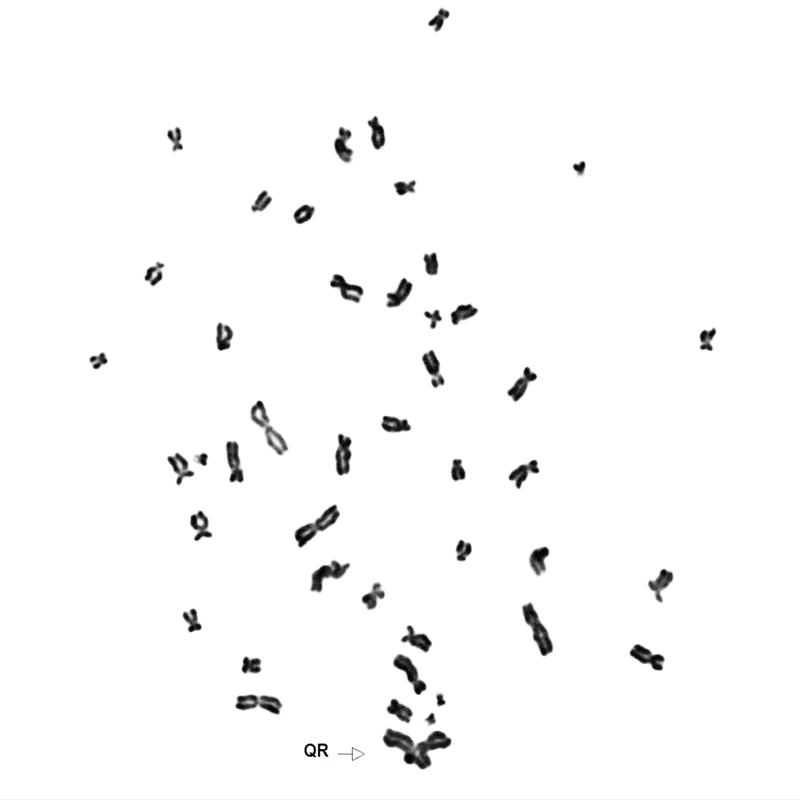 Karyotyp von HAP1 Zellen ohne FANCC-Gen, für 24 h mit MMC behandelt. QR = quadri radial Chromosomenvernetzungen