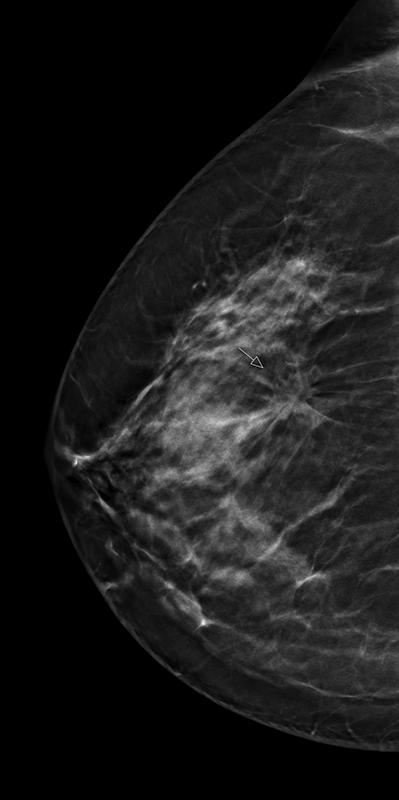 Digitale Tomosynthese der Brust: Studien zeigen, dass spikulierte, also "sternförmige" Herdbefunde (siehe Pfeil) mit Hilfe der Tomosynthese leichter diagnostiziert werden können.