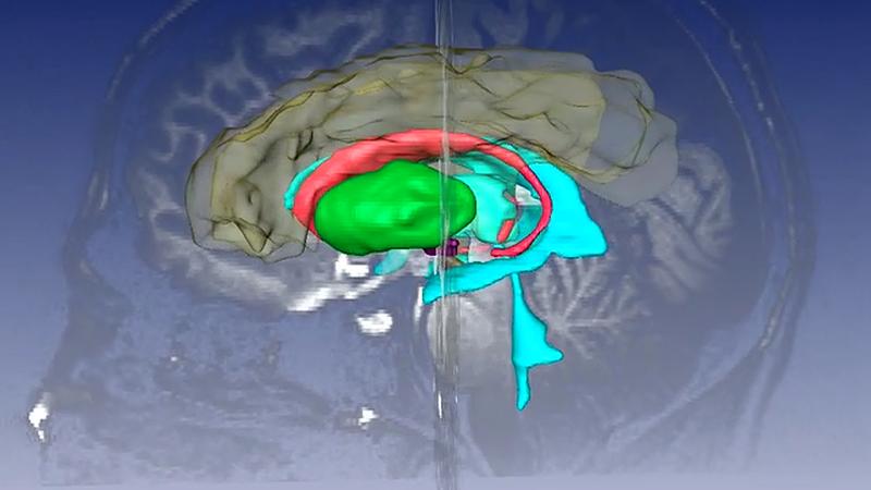 3D-Rekonstruktion der vorrangig im Chemnitzer Projekt untersuchten Gehirnregionen: Rot markiert ist das Striatum, ein Teil der Basalganglien. 