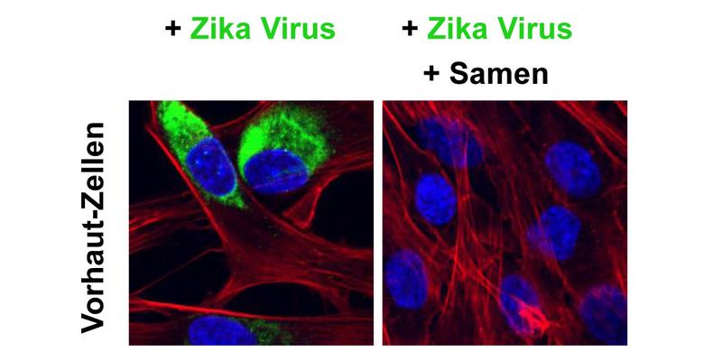 Confocal fluorescence microscopic image of foreskin fibroblasts: Visible are the nuclei in blue, the cytoskeleton in red and Zika proteins (showing sites of viral replication) in green.