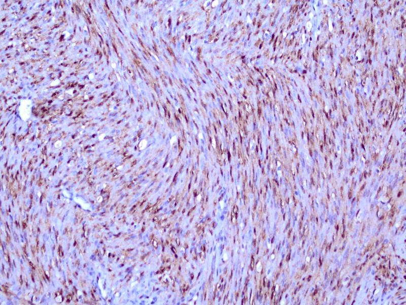 Classical mesoblastic nephroma with typical bundles of spindle cells showing a strong nuclear positivity for pERK.