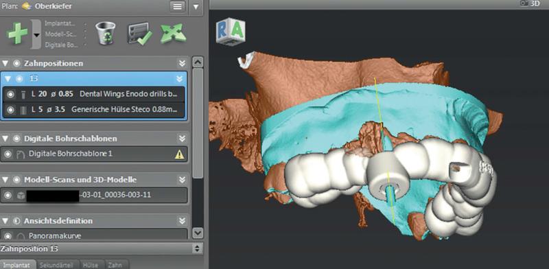 Microguided Endodontics: Eine individuell gefertigte Bohrschablone mit integrierter Bohrhülse bringt den Bohrer punktgenau ans Ziel.  