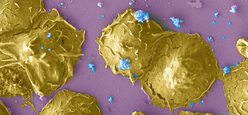 Polymorphic nuclear leukocytes infected with Chlamydia (blue)