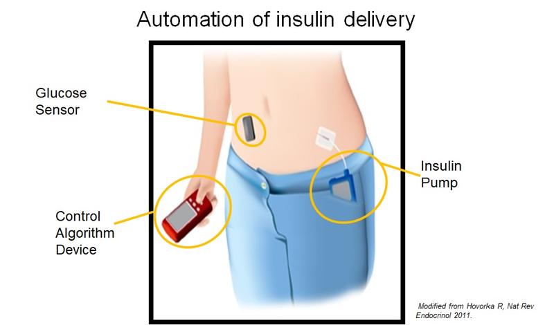 Schematic illustration of the artificial pancreas’ components.