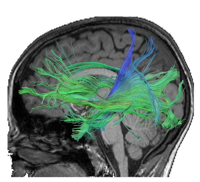 Fiber connections associated with the retrieval of numeric facts. Media-based training strengthened the conductivity of the fibers connected to long-term memory.