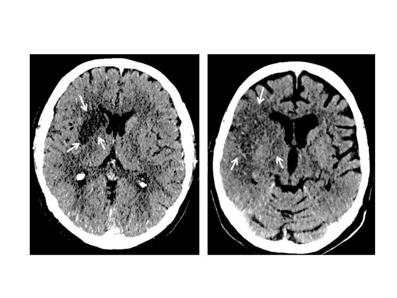 CT-Bild vom Gehirn eines Schlaganfall-Patienten: Links kleines Infarktareal – Nutzen des Kathetereingriffs ist erwiesen. Rechts größerer Infarkt – Nutzen der Behandlung noch nicht gesichert.