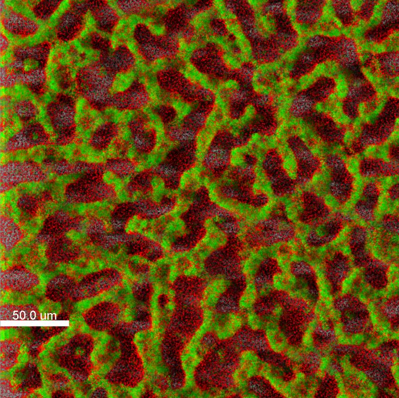 Der Krankenhauskeim Pseudomonas aeruginosa schützt sich in dichten Biofilmen vor Antibiotika und Angriffen des Immunsystems (grün = lebende Pseudomonas-Zellen; rot = tote Zellen).