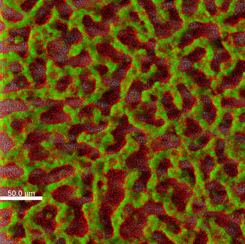 Der Krankenhauskeim Pseudomonas aeruginosa schützt sich in dichten Biofilmen vor Antibiotika und Angriffen des Immunsystems (grün = lebende Pseudomonas-Zellen; rot = tote Zellen).