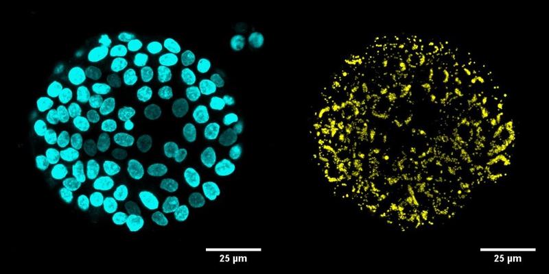 Immunofluoreszente Mikroskopieaufnahmen von Organoiden mit DAPI-(blau) und LD540-(gelb) Färbung von einem DGAT1-defizienten Patienten