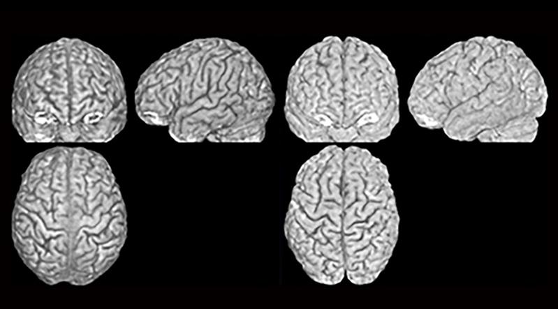 Three brain scans (from the front, side and above) of two different brains (pictured on the left and on the right) belonging to twins. The furrows and ridges are different in each person.