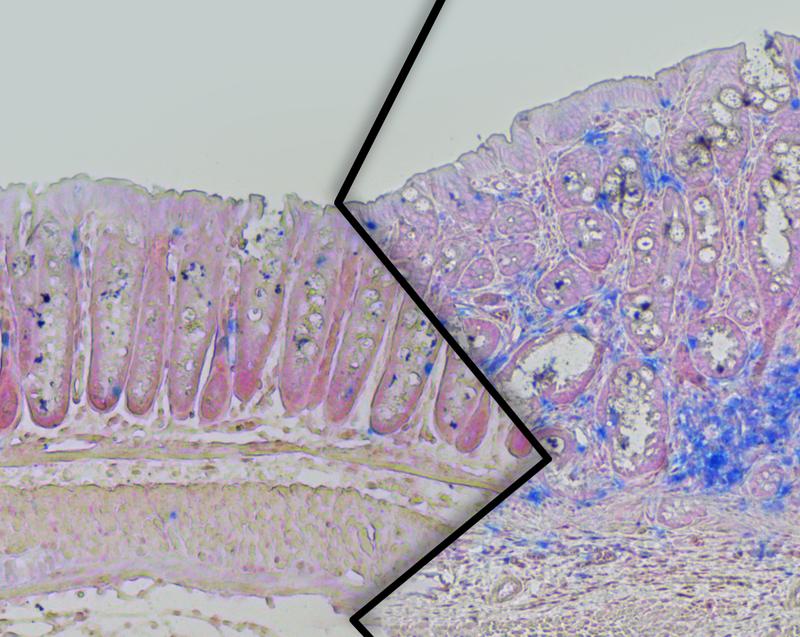 Colonic tissue from lean (left) and overweight (right) mice of the colon cancer study. In the overweight animals, an enhanced tumor growth with increased numbers of immune cells (blue) can be seen.