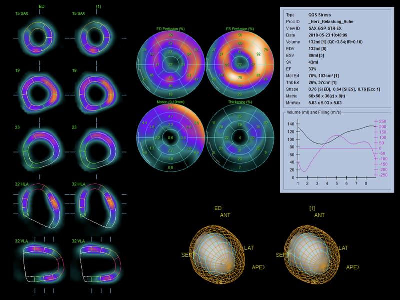 Mit dem neuen Herz-SPECT können Ärzte die Durchblutung des Herzens sehr gut untersuchen.