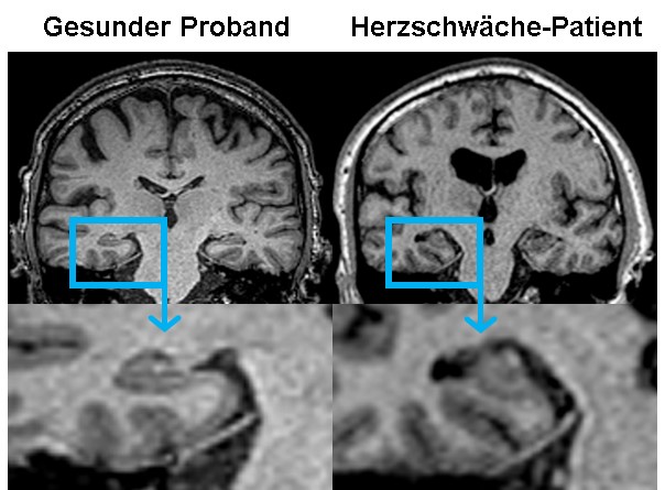 Die Studie Cognition.Matters-HF zeigt: Das schwache Herz beeinflusst die Hirnfunktion; links das MRT-Bild des Hippocampus von gesunden Probanden, rechts die Atrophie bei Herzschwäche-Patienten.