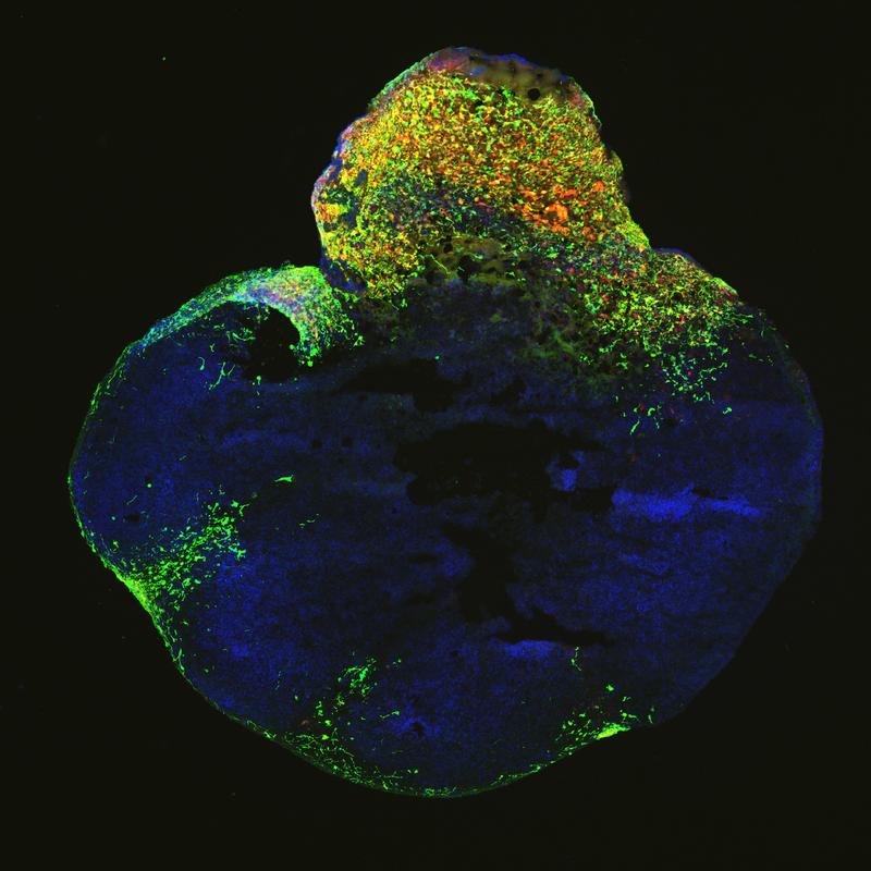 Neoplastisches Gehirn-Organoid mit GFP-positiven Tumorregionen (grün), das eine Glioblastom-ähnliche Zellularität aufweist.