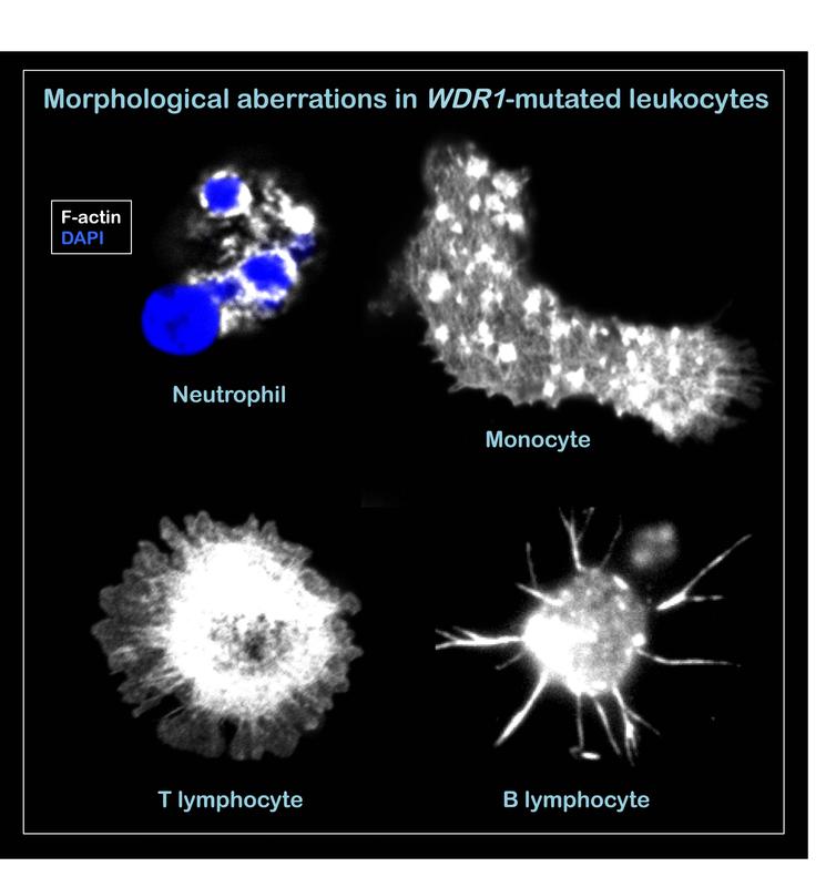 WDR1-Mutationen führen zu missgebildeten Immunzellen. Konfokalmikroskopieaufnahmen von vier verschiedenen morphologischen Abweichungen in Leukozyten, die im Blut von WDR1-Patienten gefunden wurden