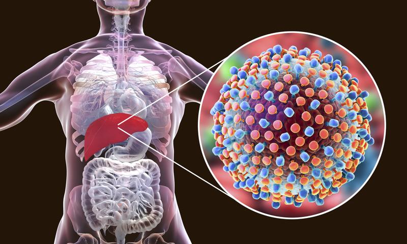 Leberentzündungen werden meist durch eine Infektion mit Hepatitis-Viren verursacht.