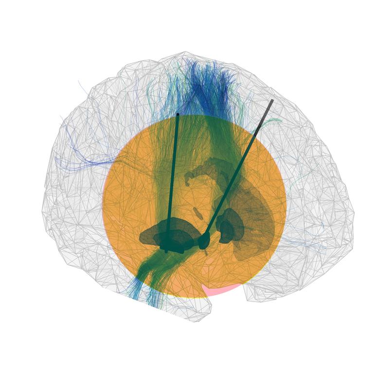 Das menschliche Gehirn als Computersimulation: Durch die implantierten Elektroden der Tiefen Hirnstimulation erhält man Einblicke in die neuronalen Funktionen der Basalganglien und deren Nervenbahnen 
