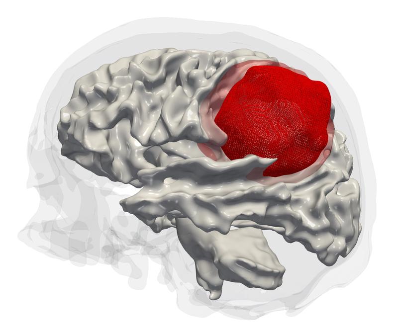 Ein aggressiver Hirntumor (Glioblastom), dargestellt auf Basis von Magnetresonanzdaten