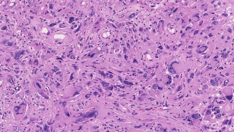 Mikroskopisches Bild eines Glioblastoms nach operativer Entfernung und Einfärbung für die neuropathologische Diagnostik 